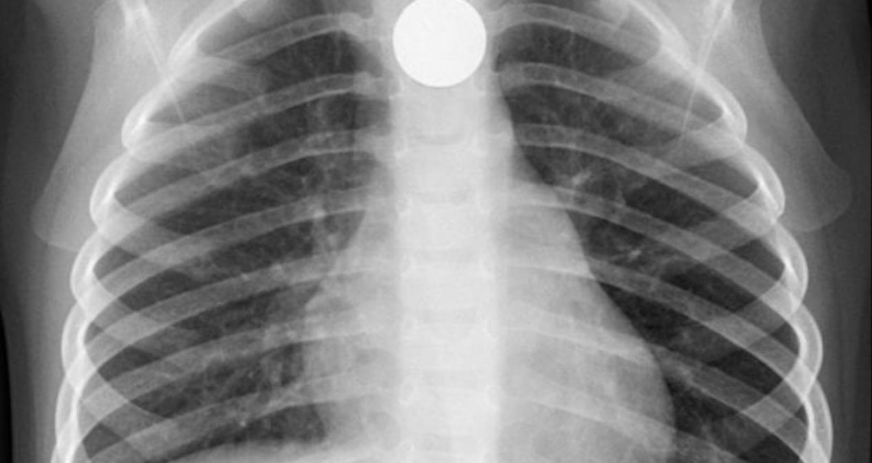 806 TL’lik yumurtayı yuttu, polis karnından çıkarmaya çalışıyor